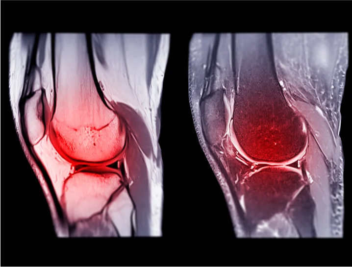 MRI scan of knee showing ACL tear and ligament damage.